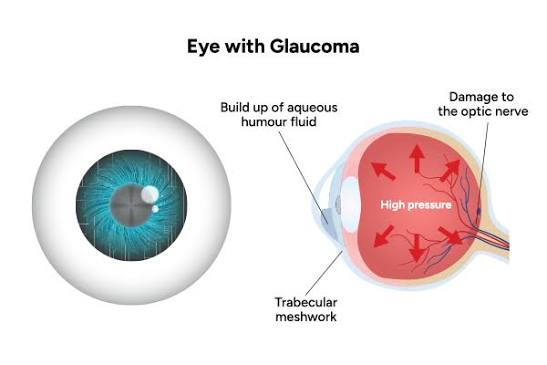 Glaucoma