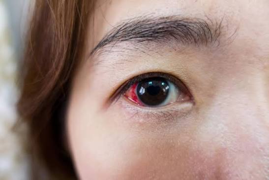 Retinal Detachment