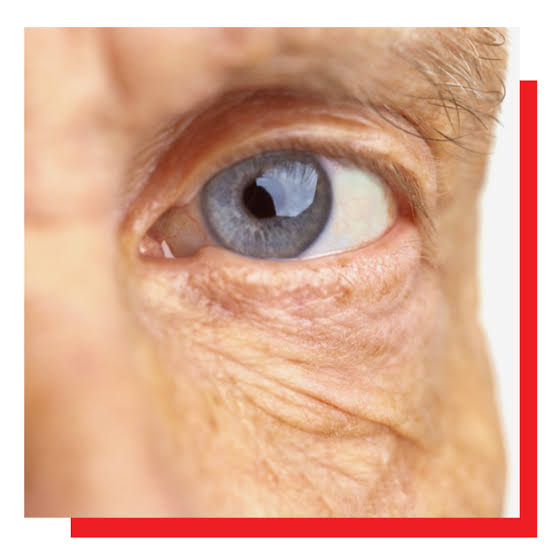 Diabetic Retinopathy