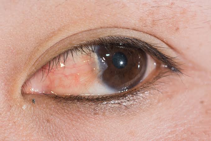 Pterygium