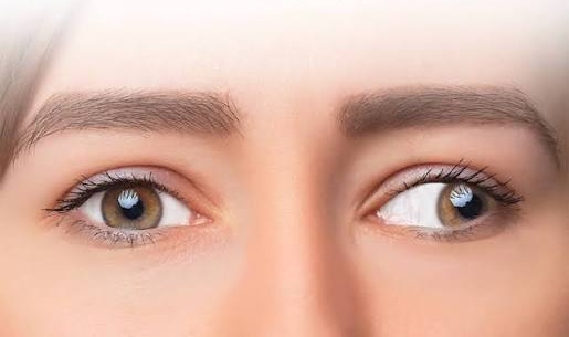 Squint (Strabismus)