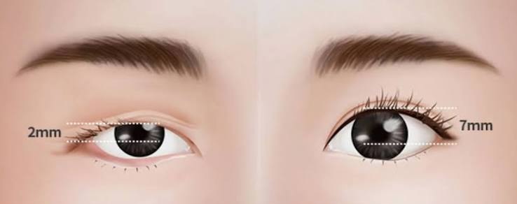 Ptosis
